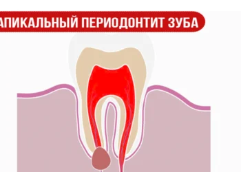 Апикальный периодонтит зуба