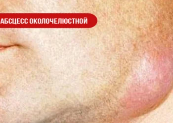 Абсцесс околочелюстной