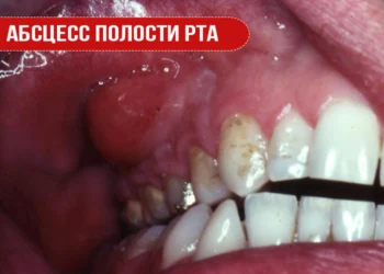 Абсцесс полости рта