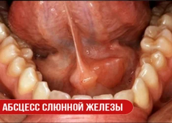 Абсцесс слюнной железы