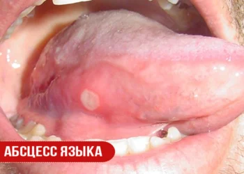 Абсцесс языкa
