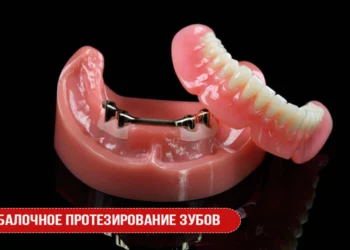 Балочное протезирование зубов