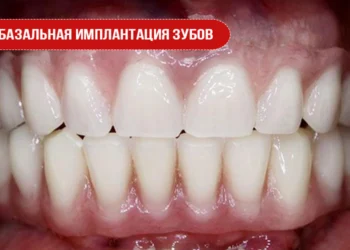 Базальная имплантация зубов