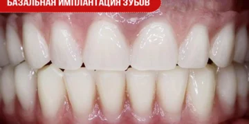 Базальная имплантация зубов