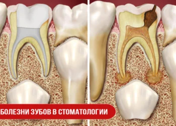 Болезни зубов в стоматологии