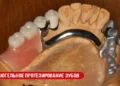 Бюгельное протезирование зубов