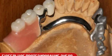 Бюгельное протезирование зубов