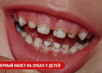 Черный налет на зубах у детей