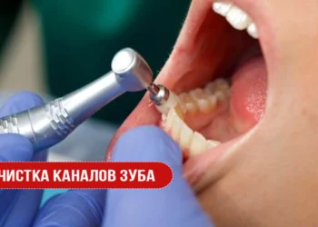 Чистка каналов зуба