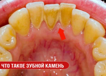Что такое зубной камень