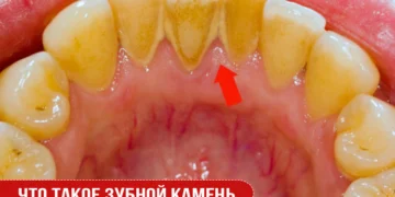 Что такое зубной камень