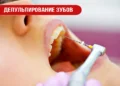 Депульпирование зубов