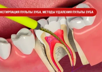 Экстирпация пульпы зуба, методы удаления пульпы зуба