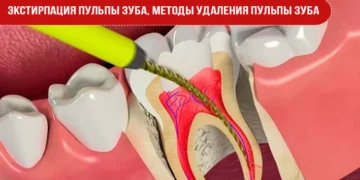Экстирпация пульпы зуба, методы удаления пульпы зуба