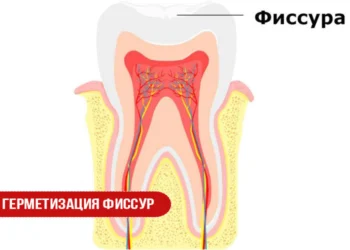 Герметизация фиссур