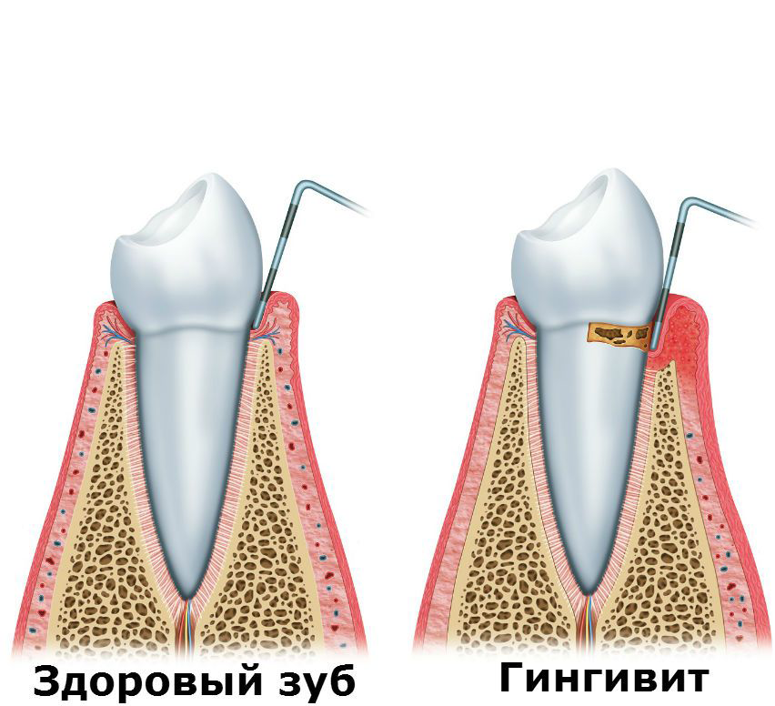 Гингивит