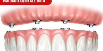 Имплантация All-on-4