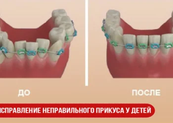 Исправление неправильного прикуса у детей