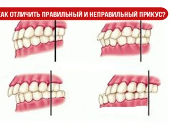 Как отличить правильный и неправильный прикус?