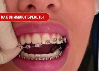 Как снимают брекеты