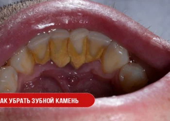 Как убрать зубной камень