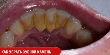 Как убрать зубной камень