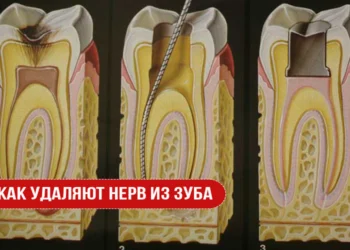 Как удаляют нерв из зуба