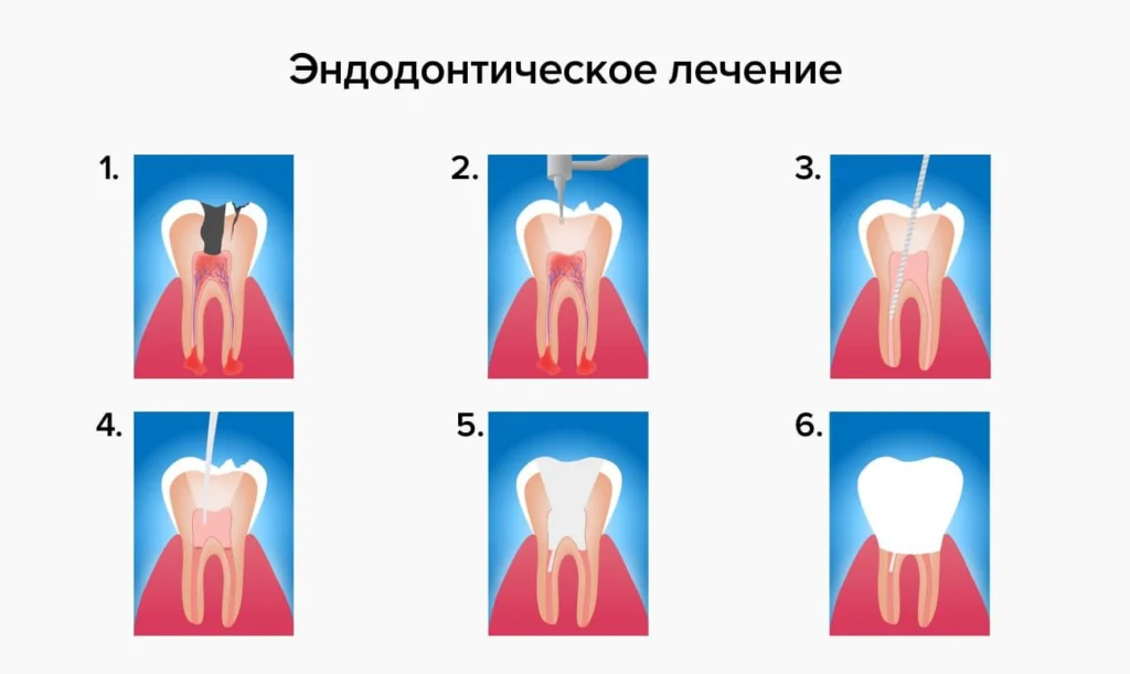 Как лечить флюс на десне