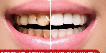 Ламинирование зубов: белоснежная улыбка видна без очков