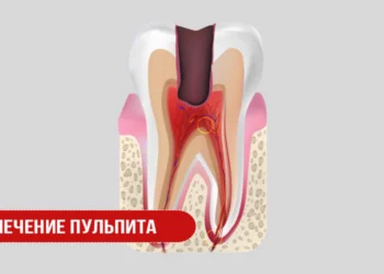 Лечение пульпита