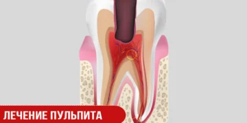 Лечение пульпита