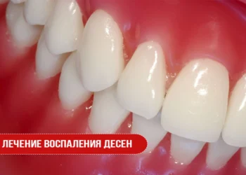 Лечение воспаления десен
