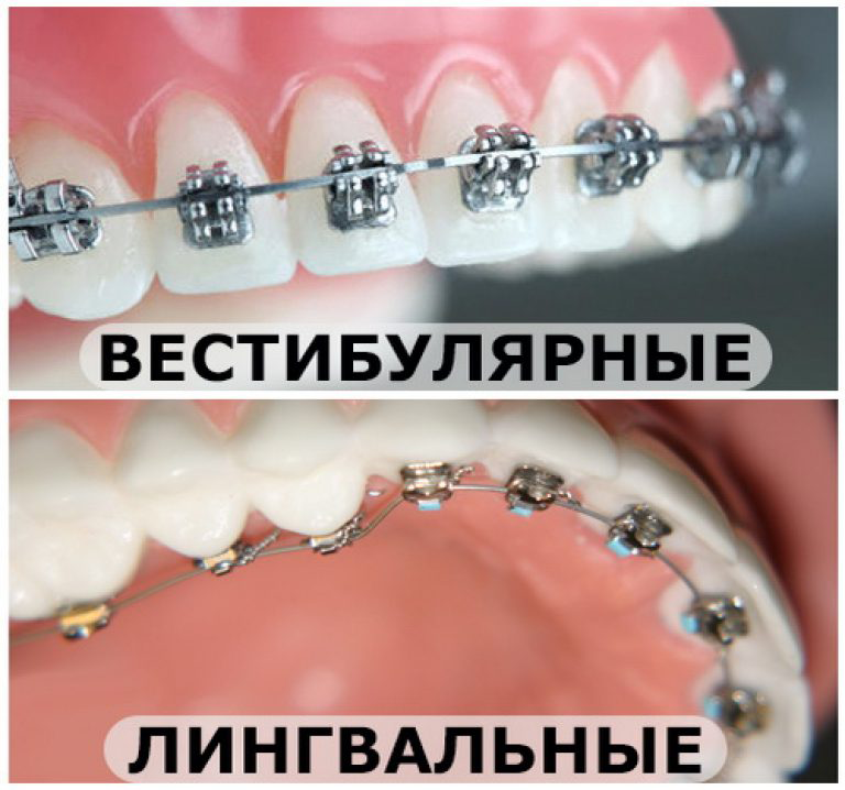 Лингвальные брекеты