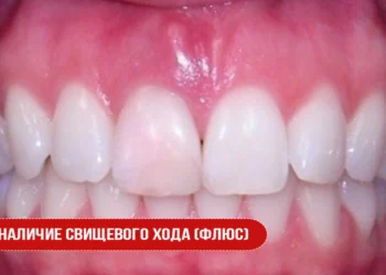 Наличие свищевого хода (флюс)