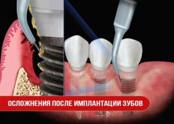 Осложнения после имплантации зубов