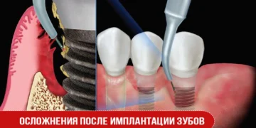 Осложнения после имплантации зубов