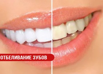 Отбеливание зубов