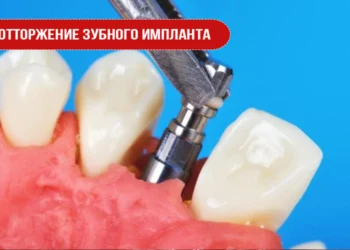 Отторжение зубного импланта