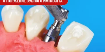 Отторжение зубного импланта