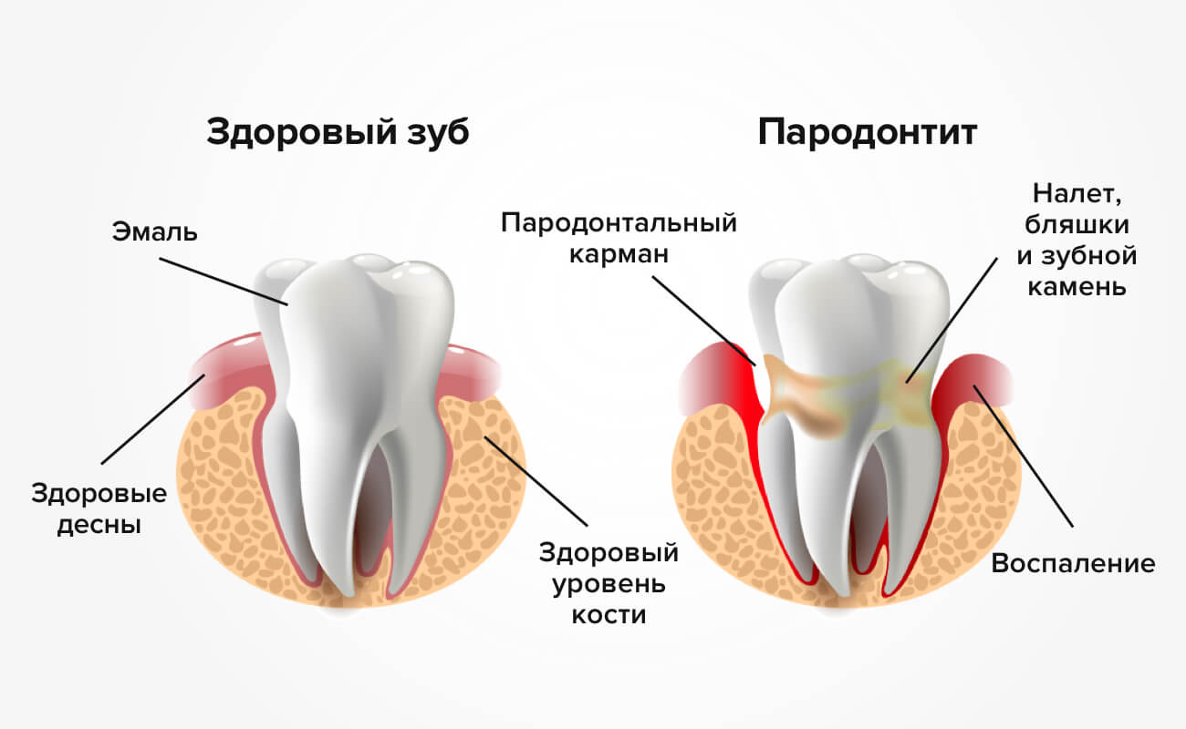 Пародонтит 