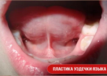 Пластика уздечки языка