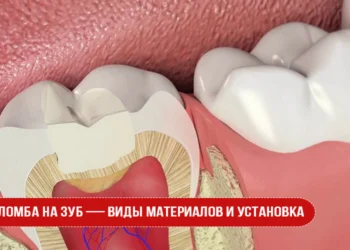 Пломба на зуб — виды материалов и установка