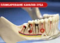 Пломбирование каналов зуба
