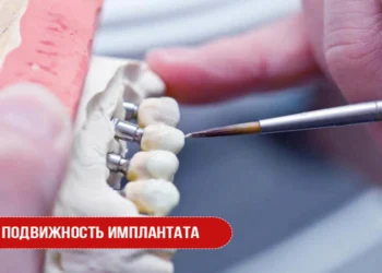 Подвижность имплантата