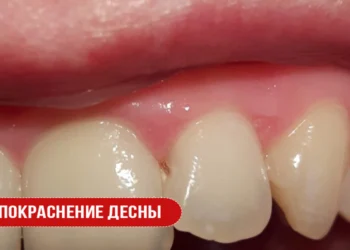 Покраснение десны