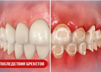Последствия брекетов