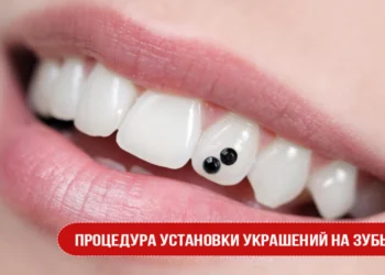 Процедура установки украшений на зубы
