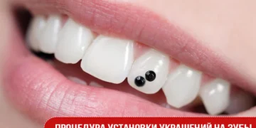 Процедура установки украшений на зубы