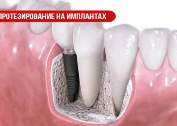 Протезирование на имплантах