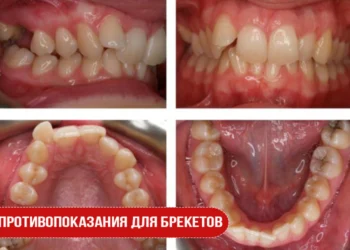 Противопоказания для брекетов